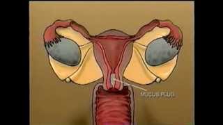 CDC Pelvic Inflammatory Disease