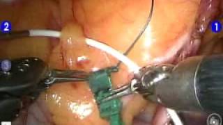 TECAB - Totally Endoscopic Coronary Artery Bypass