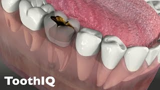 Dental Abscess