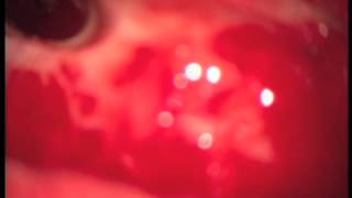 Koklear implant