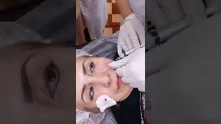 Эстефил под глазами