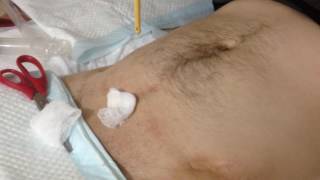 Замена цистостомы в домашних условиях