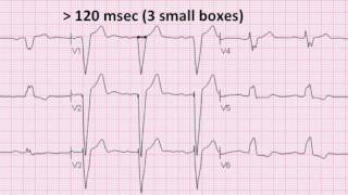 Left Bundle Branch Block