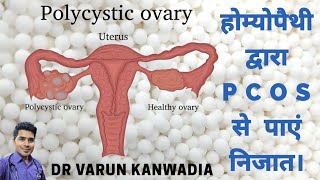 5 BEST HOMEOPATHY MEDICINES FOR PCOS ( POLYCYSTIC OVARIAN SYNDROME )
