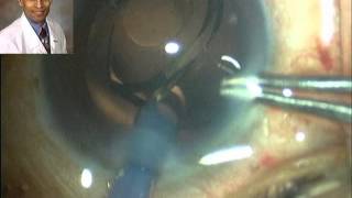 Topical Phacoemulsification Multifocal IOL Implantation & Intracameral Injection of Moxifloxacin