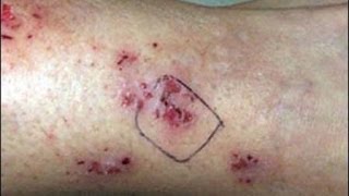 ЧЕРВИ ПОД КОЖЕЙ - болезнь Моргеллонов на славянской земле