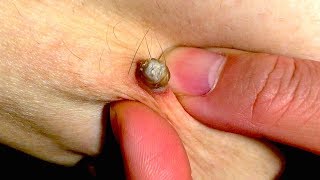 Новое выдавливание ПРЫЩЕЙ и ЧЕРНЫХ ТОЧЕК!  p23