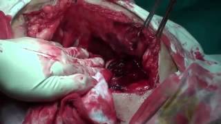 20110919 Đa vết thương ruột lần 2 Recurrent intestinal multi stab wounds   YouTube