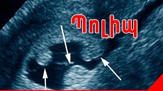 Պոլիպ | Արգանդի պոլիպ | Պոլիպների հեռացում