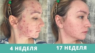 Дневник АКНЕкутана 14. Два прыща и депрессия