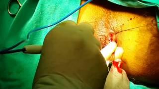 Dr EMAD T SALİH : HEMOROİDECTOMY BY LİGASURE
