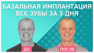 Как стать счастливым! ? Отзыв пациента об имплантации зубов за 3 дня в клинике Smile-at-Once