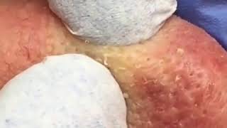 Выдавливание черных точек, угрей на носу⁄Nose Blackheads Squeezing1
