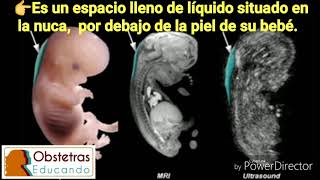 Aprende sobre la TRANSLUCENCIA NUCAL