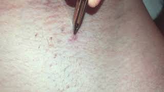 ingrown hair in the bikini zone, removal/вросший волос в зоне бикини, удаление