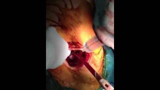 minimally invasive hip replacement posterior approach dr.gakis athens greece