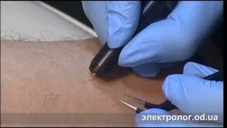 Электроэпиляция мужчина