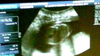 Pelvic ultrasound girl