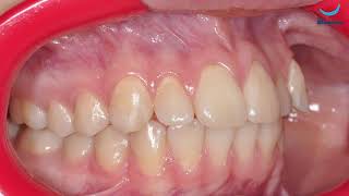 Короткая уздечка языка. Догару А. М. Клиника Dr. Smile