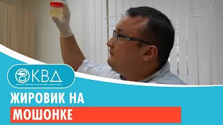 Жировик на мошонке. Клинический случай №75