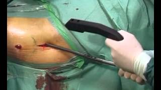 Sirus Femur OP Video