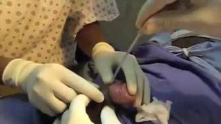 Adult male Gomco Circumcision with tissue adhesive to prevent HIV transmission.