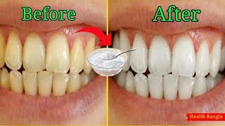 মাত্র ২ মিনিটে হলদে দাঁত সাদা ঝকঝকে করার ঘরোয়া উপায় | get White tooth in two minutes | Health Bangla