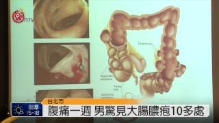 小心腹痛!罹憩室膿疱有致命風險 2014-11-20 TITV 原視新聞