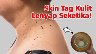 CUKUP PAKAI INI, SKINTAG ATAU BOLA-BOLA DAGING PADA KULIT HILANG