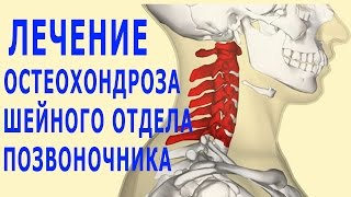★Как лечить ОСТЕОХОНДРОЗ ШЕЙНОГО ОТДЕЛА позвоночника. Медикаментозное лечение, гели и мази.