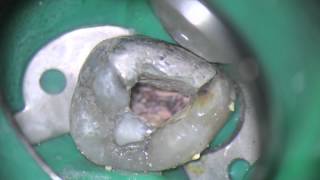 Access cavity preparation