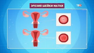 Гинекологические заболевания, которых нет. Доктор И...
