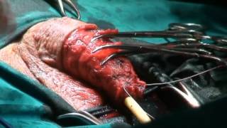 Glansectomy with tunica vaginalis as a graft/Βαλανεκτομή με ιδίως ελυτροειδή σαν μόσχευμα