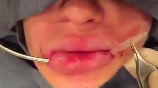 Implante de labio.