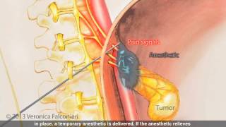 Celiac Plexus Block for Pancreatic Cancer Pain