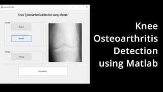 Knee Osteoarthritis Detection using Matlab