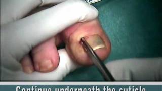 ingrown toenail surgical treatment