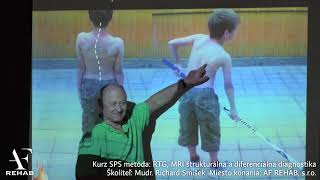 Skolióza a šport