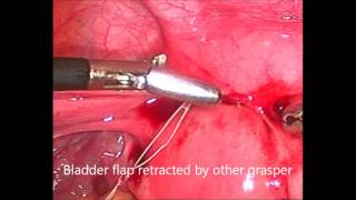 Laparoscopic removal of embedded missing Copper T IUD