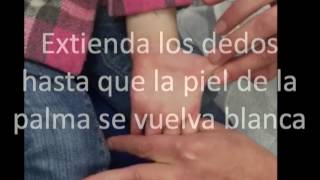 Burns 301-S: Estiramiento de Palma Pediatrica