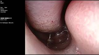 Mucosa nasal 1