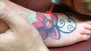 PicoWay Laser Tattoo Removal at Vamp Cosmetic Clinic Newcastle NSW