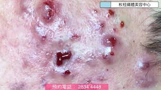 「枚桂」嚴重暗瘡皮膚處理7
