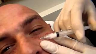 Dermal Fillers Melbourne - Chelsea Cosmetics (03) 88223472