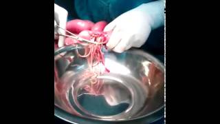 Worms in the intestine..video publish by dr Paresh Ruparel