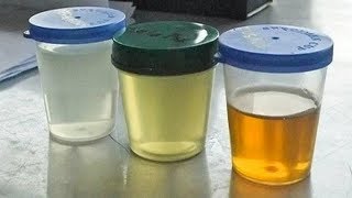 О Чём Расскажет ЦВЕТ МОЧИ? ВАЖНАЯ Информация О СОСТОЯНИИ Организма!