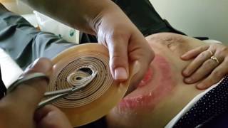 KOLOSTOMİLİ VE OSTOMİLİLER DERNEĞİ VE STOMA DEĞİŞİKLİĞİ..