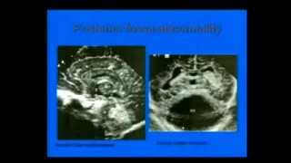 neonatal transcranial ultrasound