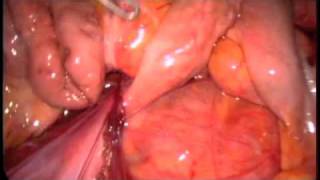 Ladd's procedure