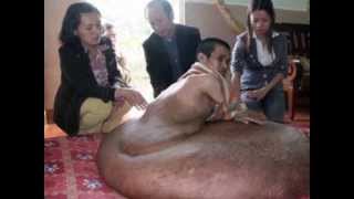 SHOCKING!! Tumor of 186 Pounds! - Man Pleads For Help.